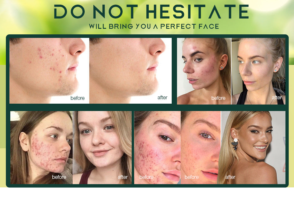 Skin Care Hyaluronic Acid Moisturiser Acne Treatment Cream For Teenager