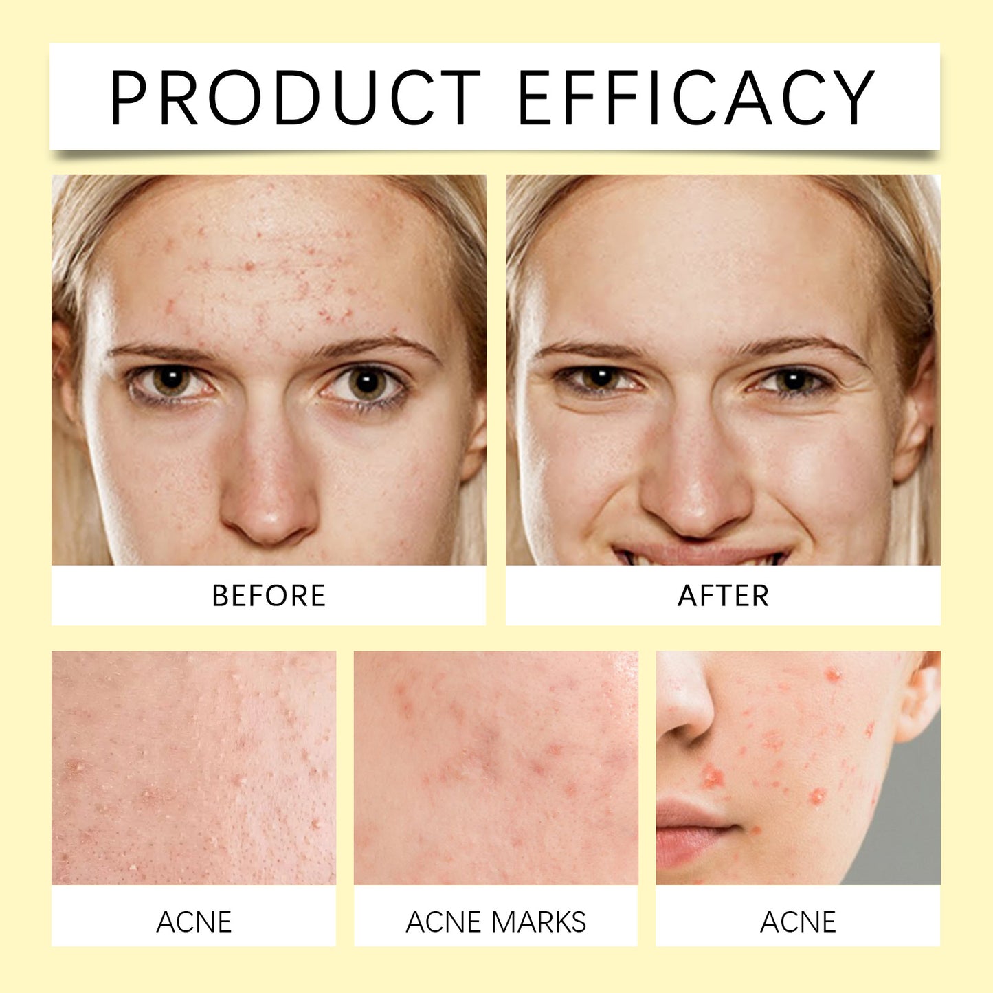 Customized Amazing Hydrocolloid Patches DIY Pimple Patch For Acne Remove