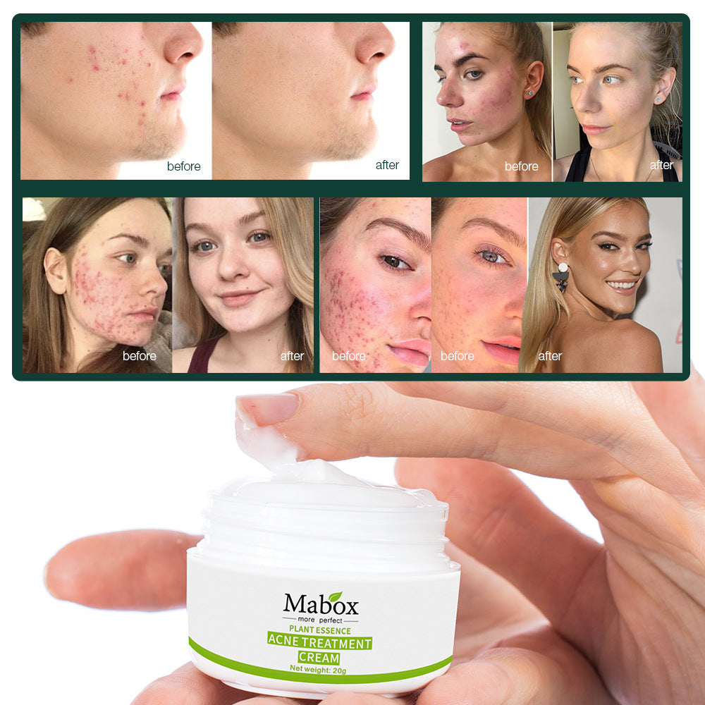 Skin Care Hyaluronic Acid Moisturiser Acne Treatment Cream For Teenager