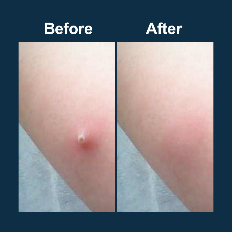 OEM Microneedle Pimple Patch Hydrocolloid Blemish Remover Acne Cover Stickers for Pimples