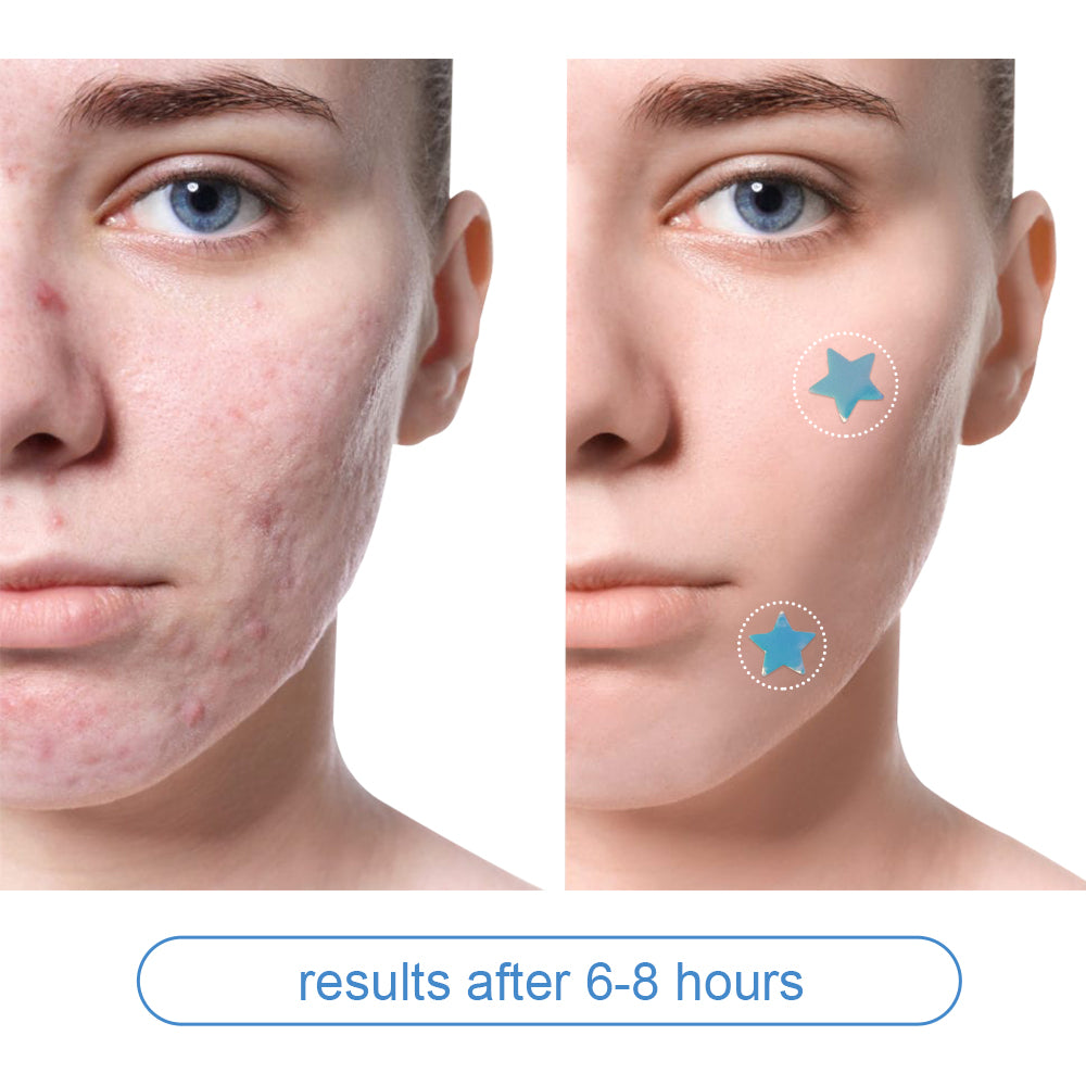 OEM Mighty Pimple Patch Invisible Diy Acne Patches for Covering Zits and Blemishes