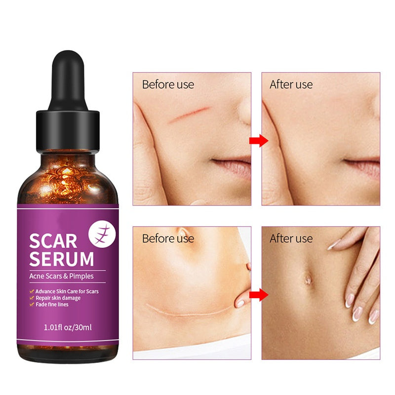 OEM Advanced Skin Care Scar Pimples Removal Serum, Treatment for Acne Scars, Stretch Marks, and Dark Spots