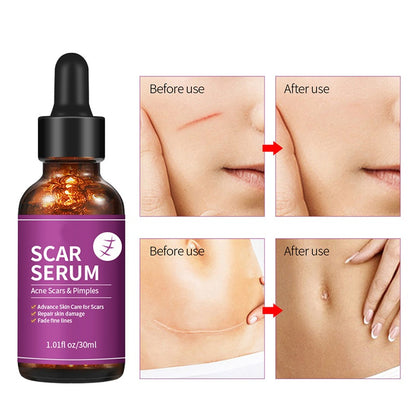 OEM Advanced Skin Care Scar Pimples Removal Serum, Treatment for Acne Scars, Stretch Marks, and Dark Spots