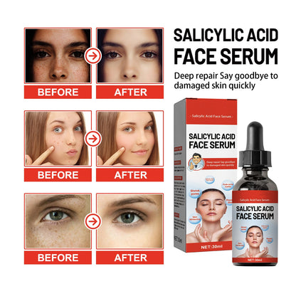 OEM Gentle Exfoliating Acne Spot Treatment Salicylic Acid Face Serum, Redness Relief