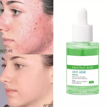 OEM Deep Cleans Pores Oil Control Salicylic Acid Serum for Acne Blackheads Supplier