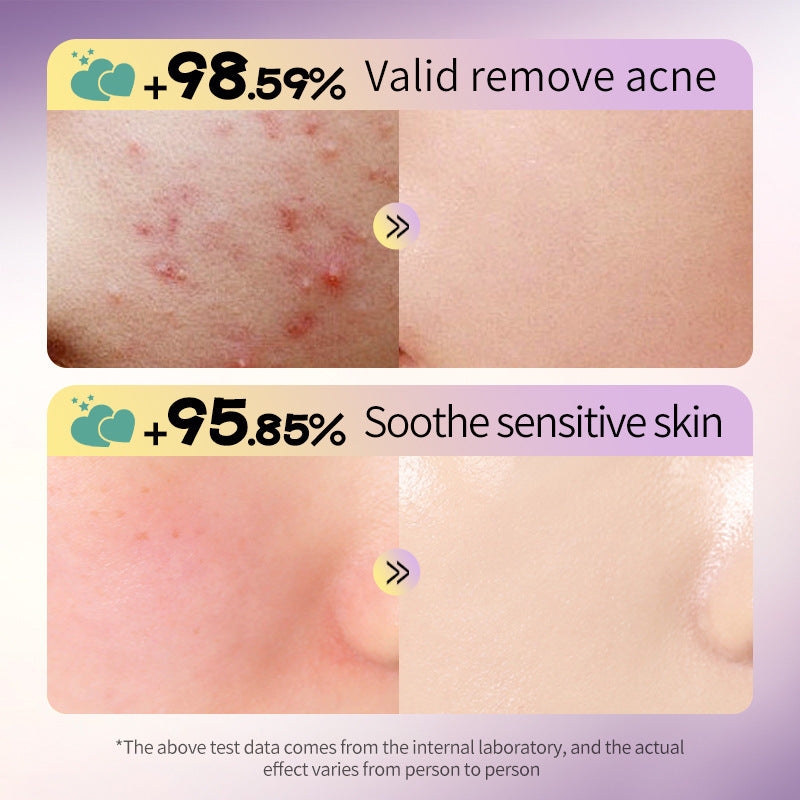 OEM Pimple Patches for Face, Hydrocolloid Acne Patches with Tea Tree, Salicylic Acid