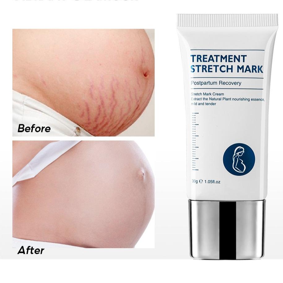 Wholesale Stretch Marks Removal Cream Moisturizing Repair Stretch Mark Cream Lotion Pregnancy Line Repair Scar Cream