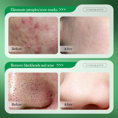 OEM Exfoliating Acne Treatment Salicylic Acid Pads for Acne & Blemishes Clear